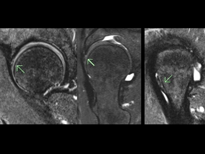 Figure 2 for case calcific periarthritis ( RID3597 )